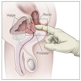 wow tuve prostatitis no cáncer
